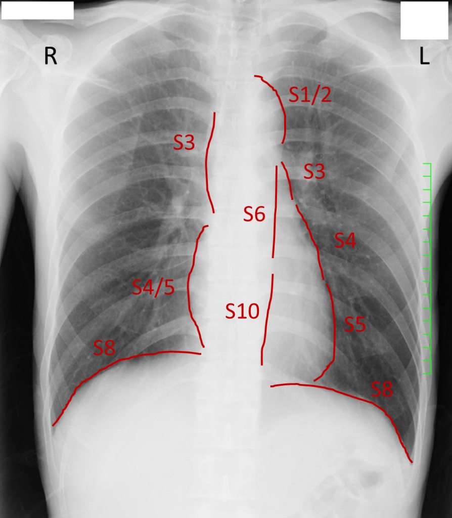 胸部 レントゲン 写真 の 見方